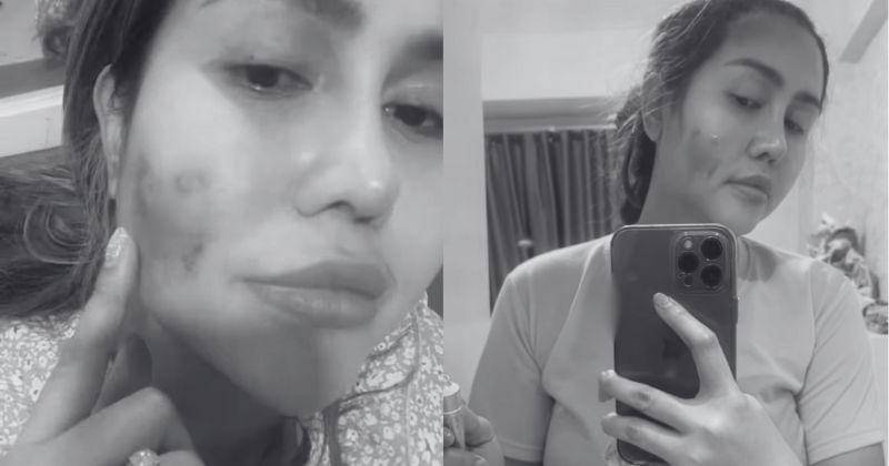 Demi kenyamanan pembaca, gambar yang menunjukkan luka telah diburamkan - Instagram.com/ratu_meta705